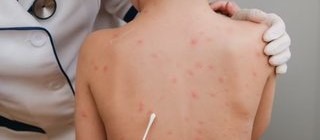 Detectan dos casos sospechosos de sarampión en Nuevo Ideal
