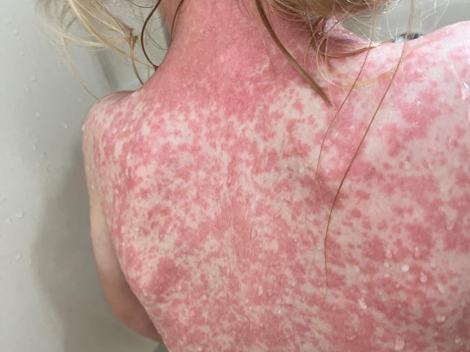 Durango reporta 18 casos de sarampión y un fallecido en menos de dos semanas