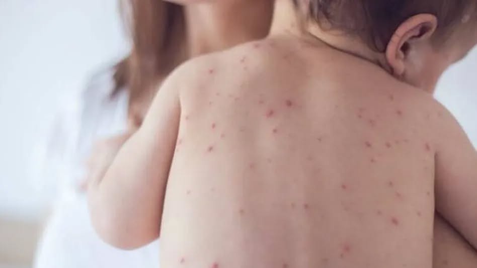 Muere bebé por sarampión en Tlaxcala; no tenía esquema completo de vacunación