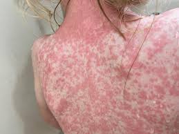 Sarampión reaparece en Durango con tres casos confirmados