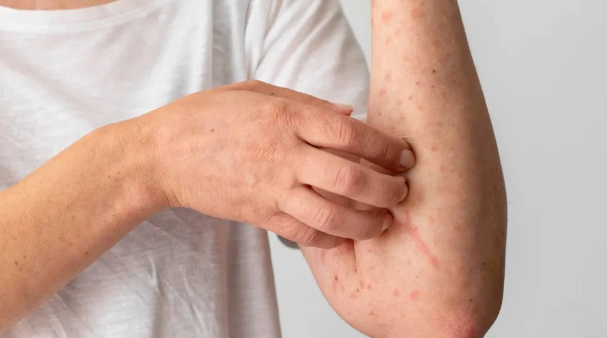 Confirman seis casos de sarampión en Durango